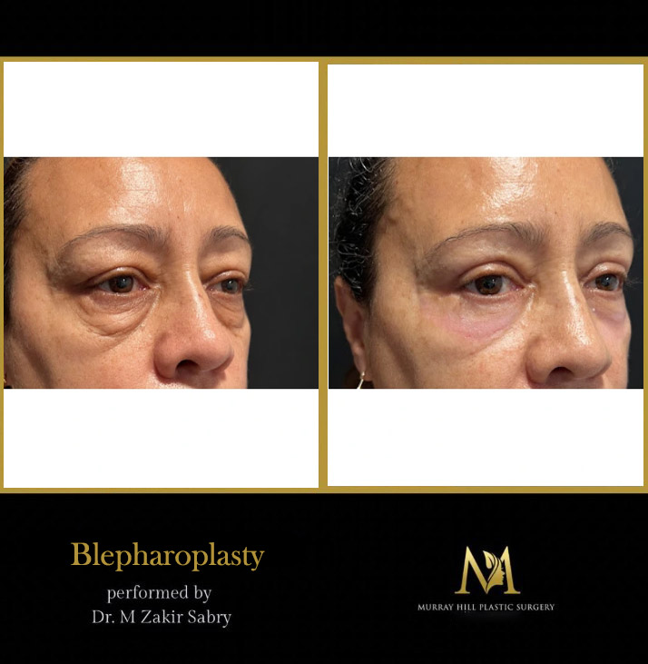 before and after male eyelid lift NYC