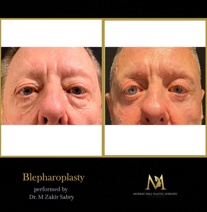 Before and after blepharoplasty front view