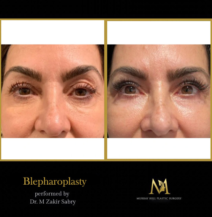 before and after female eyelid lift front view