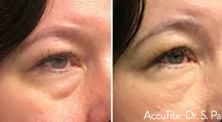 before and after accutite front view case 28865