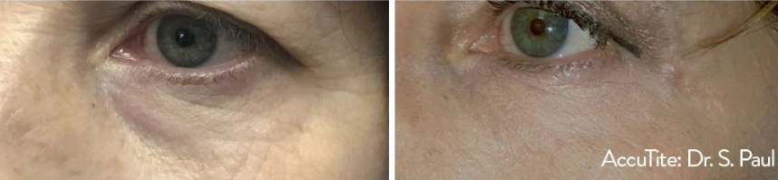 before and after accutite undereye view case 28867