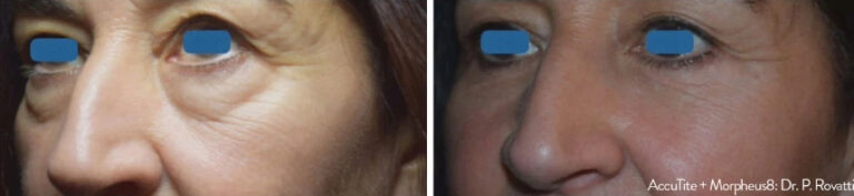 before and after accutite front view case 28869