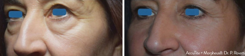 before and after accutite front view case 28869