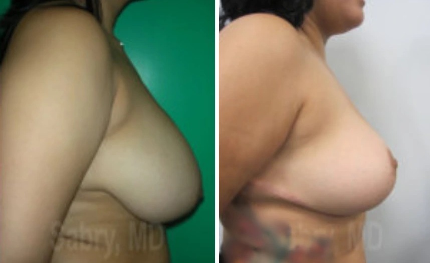 before and after breast lift right side view case 28823