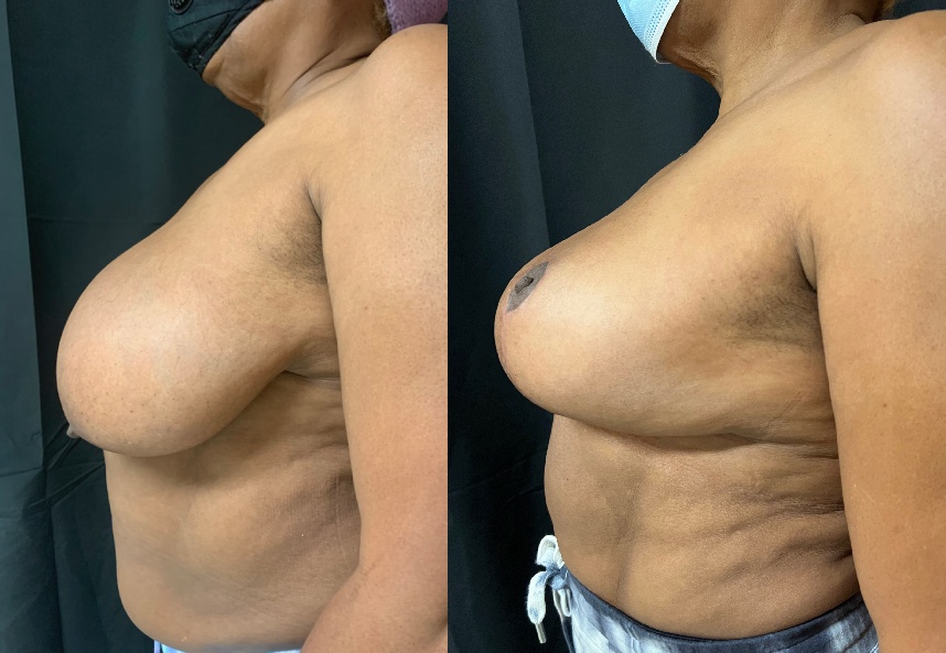 before and after breast lift NYC left side view female patient case 29434