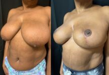 before and after breast lift NYC left angle view female patient case 29434