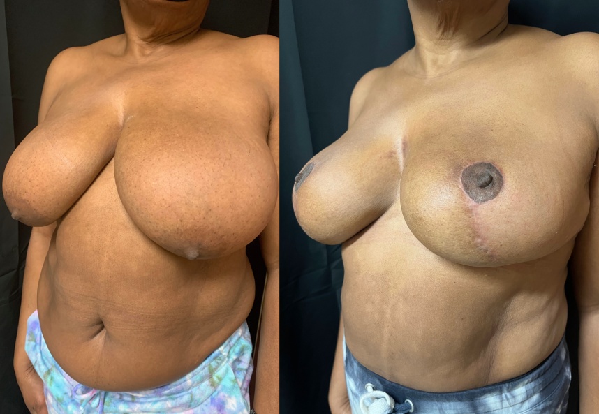 before and after breast lift NYC left angle view female patient case 29434