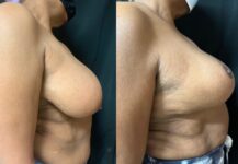 before and after breast lift NYC right side view female patient case 29434
