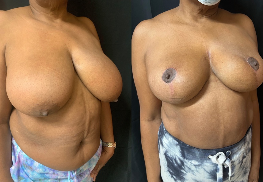 before and after breast lift NYC right angle view female patient case 29434