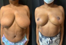 before and after breast lift NYC front view female patient case 29434
