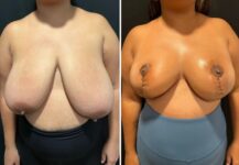 before and after breast reduction front view case 28810