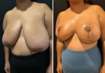 before and after breast reduction left angle view case 28810