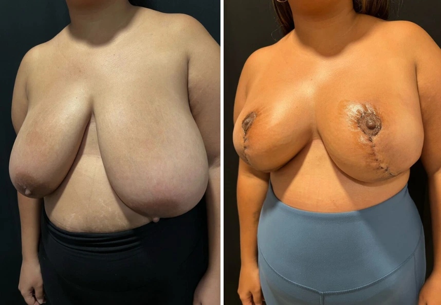 before and after breast reduction left angle view case 28810