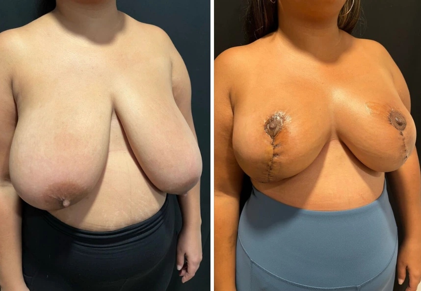 before and after breast reduction angle view case 28810