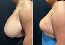 before and after breast reduction left side view case 28810