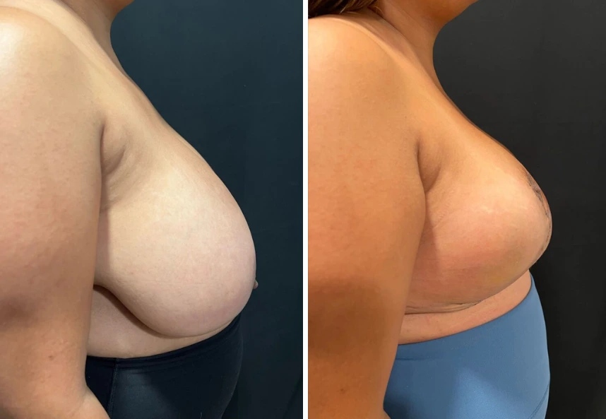 before and after breast reduction side view case 28810