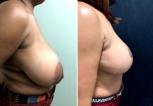 before and after breast reduction side view case 28817