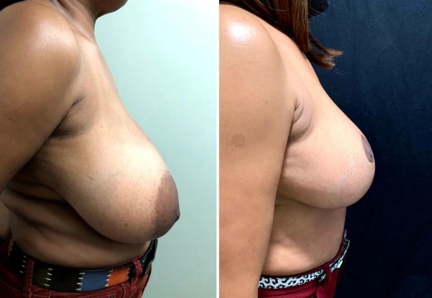 before and after breast reduction side view case 28817