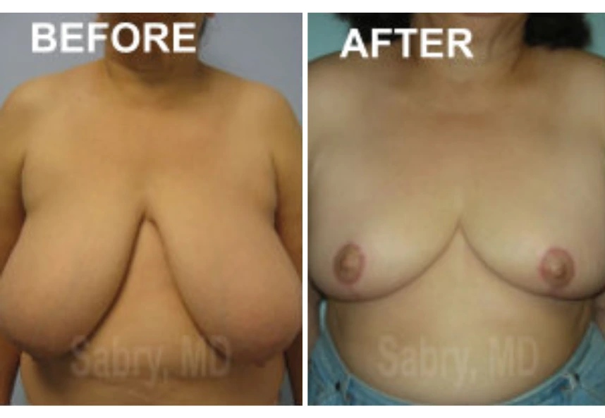 before and after breast reduction front view case 28821