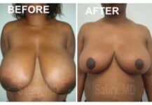 before and after breast reduction front view case 28827