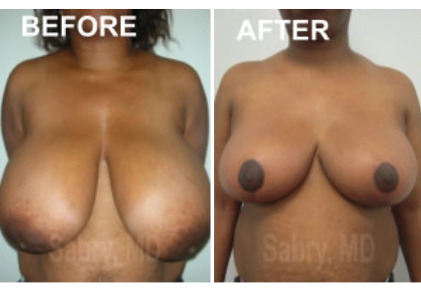 before and after breast reduction front view case 28827