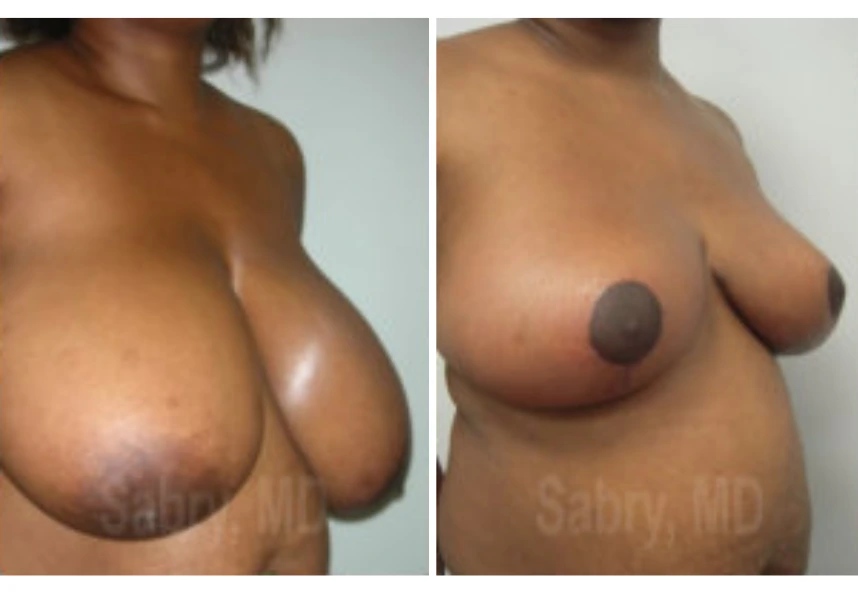 before and after breast reduction angle view case 28827