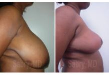 before and after breast reduction side view case 28827