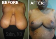 before and after breast reduction front view case 28831