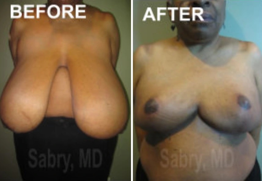 before and after breast reduction front view case 28831