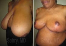 before and after breast reduction left angle view case 28831
