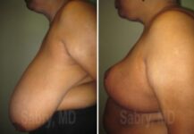 before and after breast reduction left side view case 28831