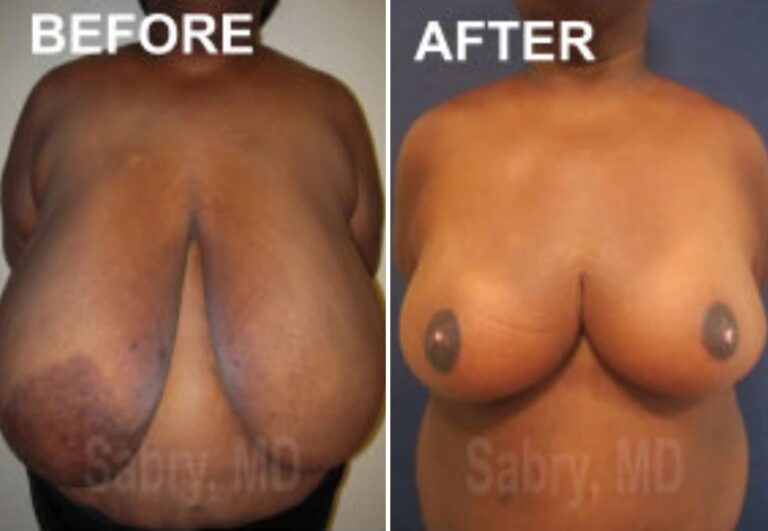 before and after breast reduction front view case 28835