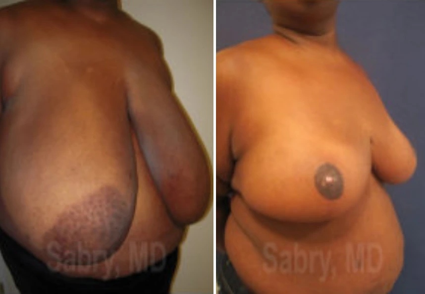before and after breast reduction angle view case 28835