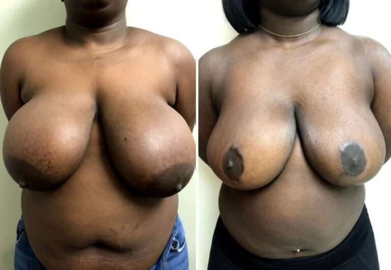 before and after breast reduction front view case 28842