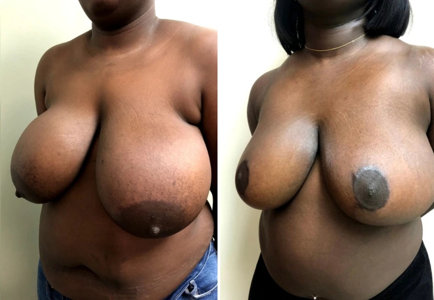 before and after breast reduction left angle view case 28842