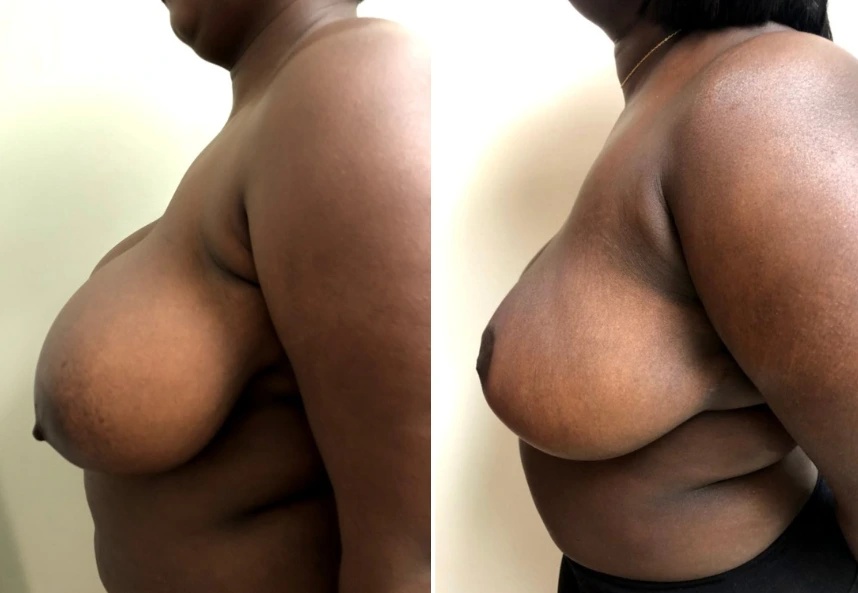 before and after breast reduction side view case 28842