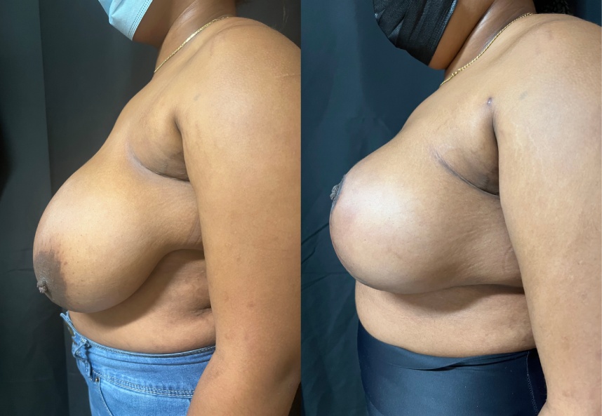 before and after breast reduction left side view female patient case 29396