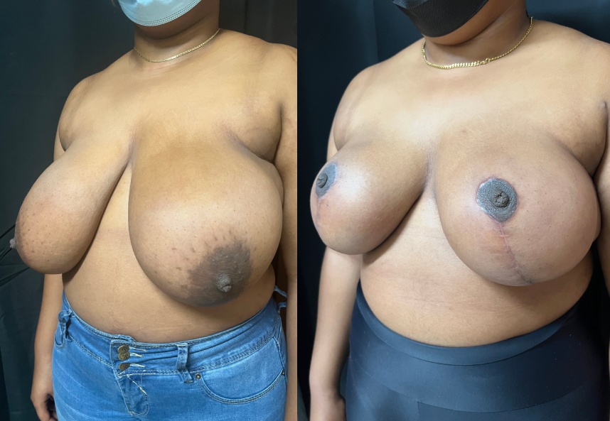 before and after breast reduction left angle view female patient case 29396