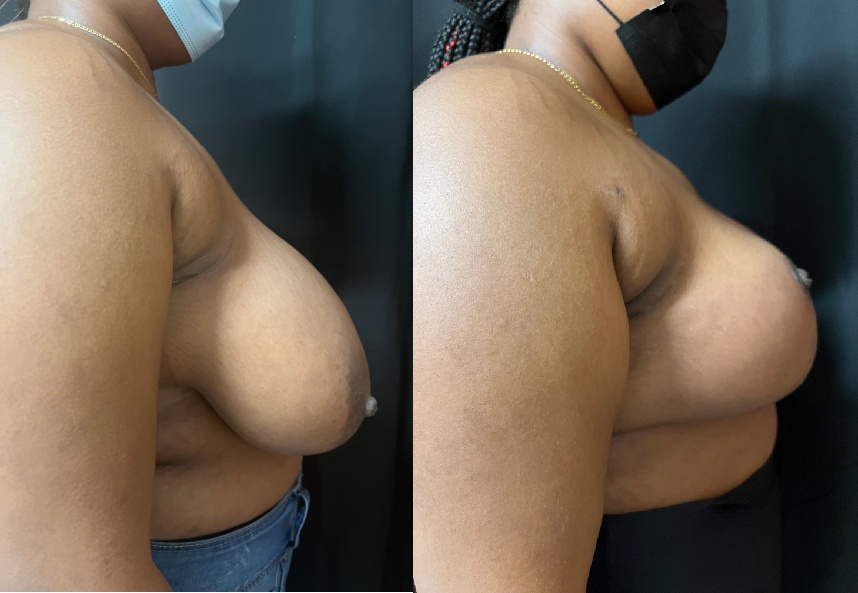 before and after breast reduction right side view female patient case 29396