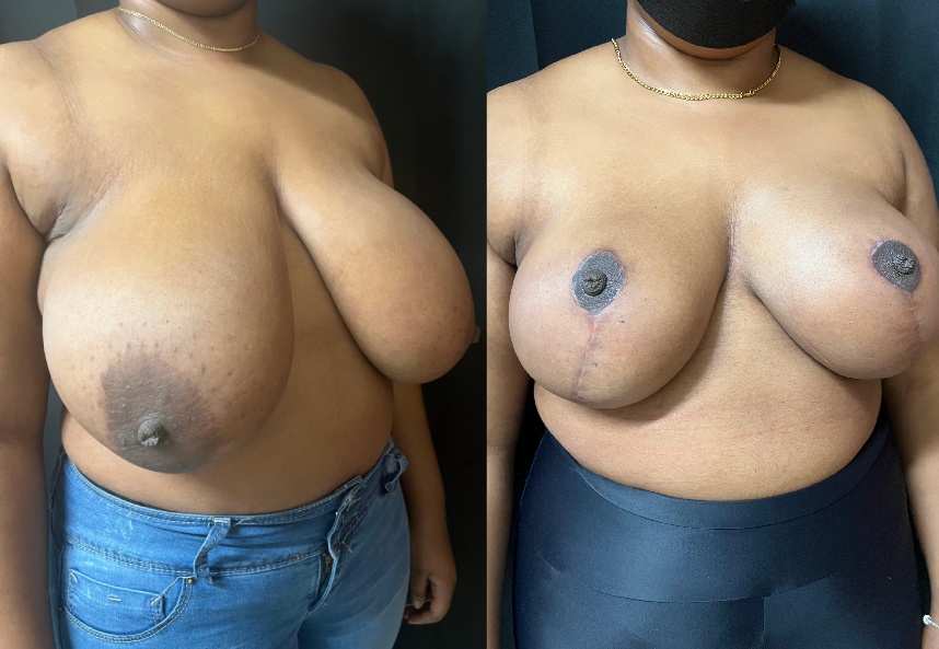 before and after breast reduction right angle view female patient case 29396