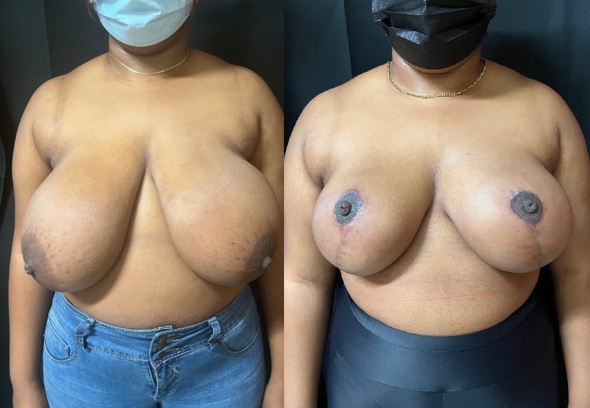 before and after breast reduction front view female patient case 29396