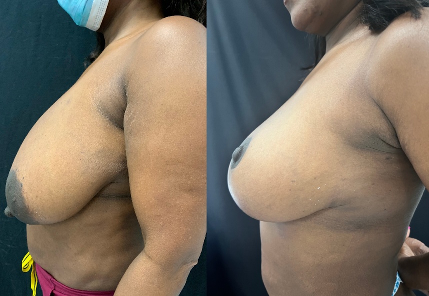 before and after breast reduction left side view female patient case 29402