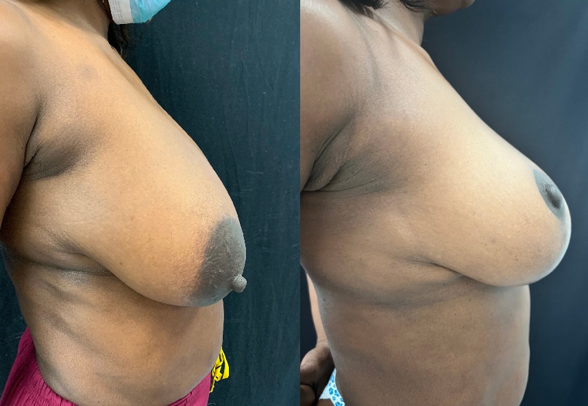 before and after breast reduction right side view female patient case 29402