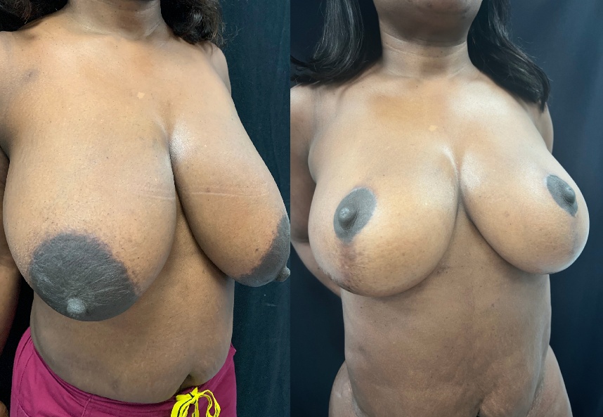 before and after breast reduction right angle view female patient case 29402