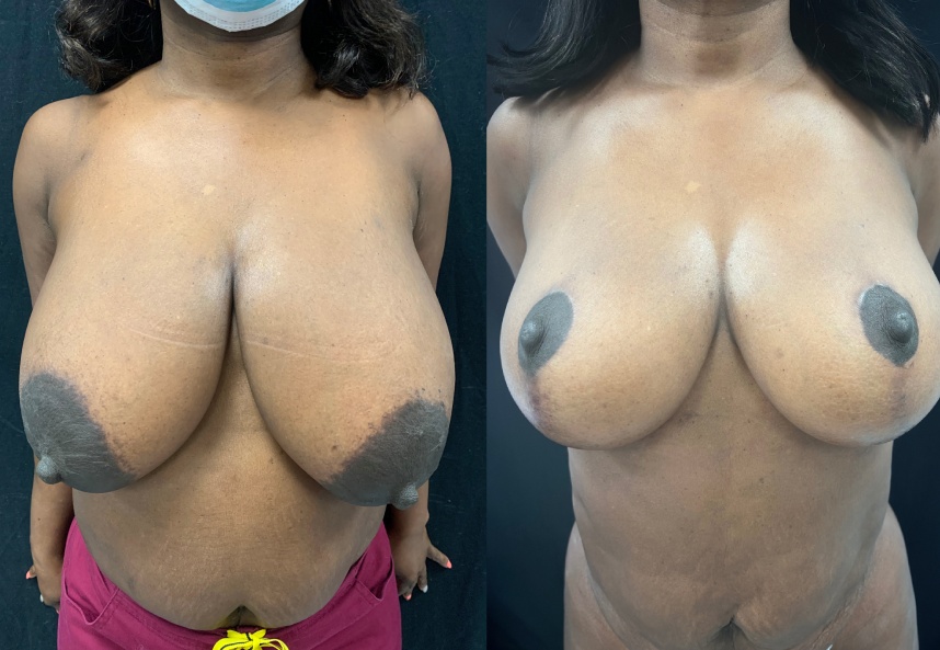 before and after breast reduction front view female patient case 29402