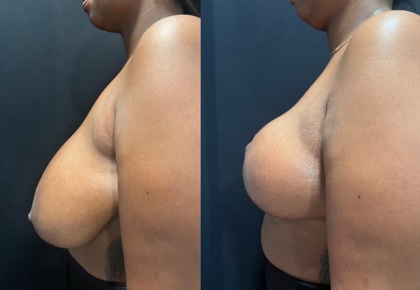 before and after breast reduction left side view female patient case 29410