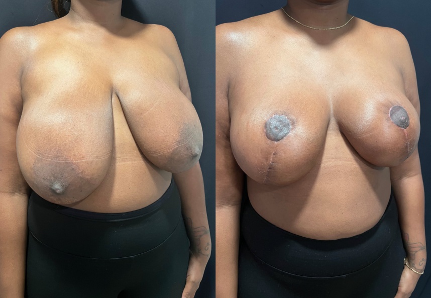 before and after breast reduction right angle view female patient case 29410