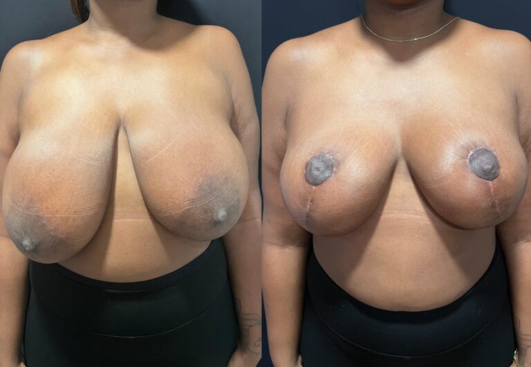 before and after breast reduction front view female patient case 29410