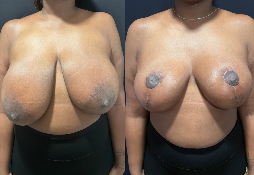 before and after breast reduction front view female patient case 29410