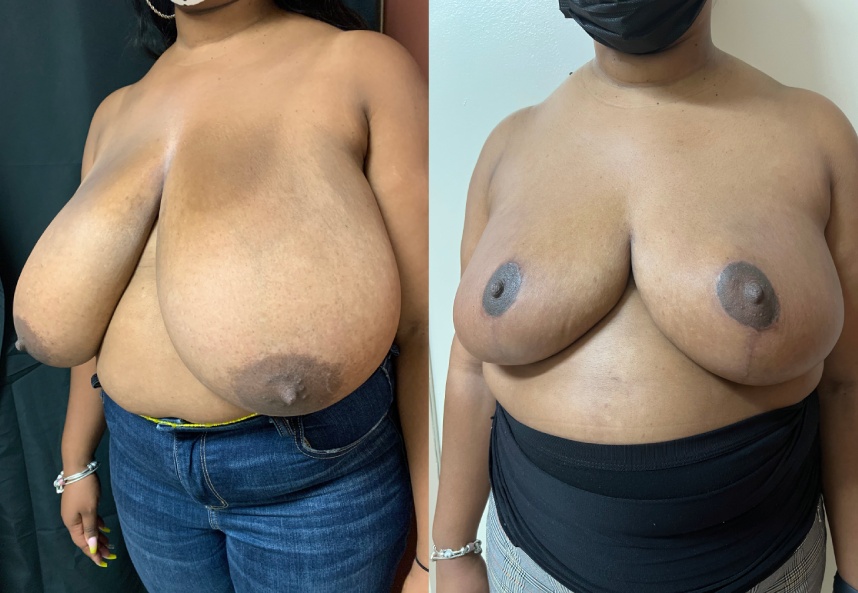 before and after breast reduction Dr. Sabry left angle view case 29453